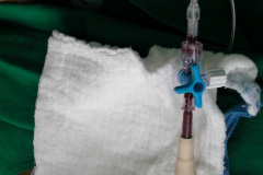 exanguinotransfusion-con-bombas-sedacion-gotas-nasales-2005-000