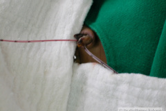 exanguinotransfusion-con-bombas-sedacion-gotas-nasales-2005-002