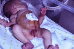 exanguinotransfusion-cuidado-posterior-000