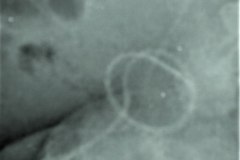falsa-ruta-cateter-venoso-femoral-izq-bilumen-2005-001