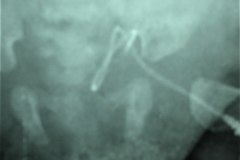 falsa-ruta-cateter-venoso-femoral-izq-monolumen-linea-arterial-femoral-der-normal-000