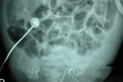 falsa-ruta-cateter-venoso-femoral-izq-monolumen-linea-arterial-femoral-der-normal-001