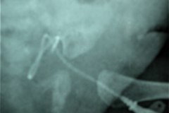 falsa-ruta-cateter-venoso-femoral-izq-monolumen-linea-arterial-femoral-der-normal-002