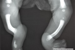 femur-fibula-ulna-femur-perone-cubito-hipoplasia-femur-der-agenesia-perone-bil-1988-000