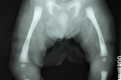 femur-fibula-ulna-femur-perone-cubito-hipoplasia-femur-der-agenesia-perone-bil-1988-001