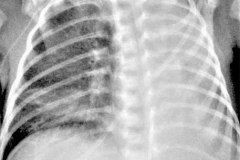 fibrosis-quistica-atelectasias-multisegmentarias-parciales-y-totales-intermitentes-11d12d29d-2010-000