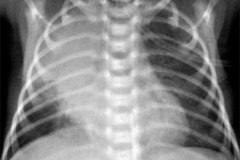 fibrosis-quistica-atelectasias-multisegmentarias-parciales-y-totales-intermitentes-11d12d29d-2010-001