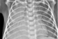 fibrosis-quistica-atelectasias-multisegmentarias-parciales-y-totales-intermitentes-11d12d29d-2010-002