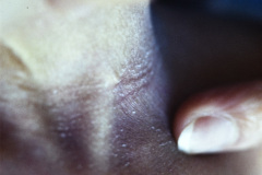 fistula-faringea-branquial-1-000