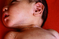 fistula-faringea-branquial-1987-002