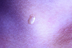 fistula-faringea-branquial-2-000