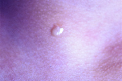 fistula-faringea-branquial-2-001