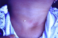 fistula-faringea-branquial-2-002