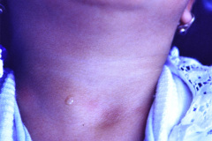 fistula-faringea-branquial-2-003