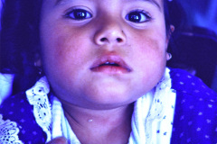 fistula-faringea-branquial-2-004