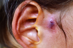 fistula-preauricular-der-infectada-1987-000