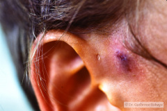 fistula-preauricular-der-infectada-1987-001