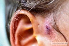 fistula-preauricular-der-infectada-1987-002