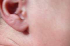 fistula-preauricular-der-002