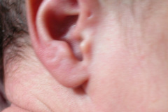 fistula-preauricular-der-003