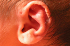 fistula-preauricular-izq-2009-000