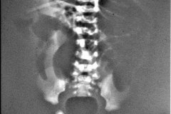 fistula-recto-vesical-atresia-anal-aire-en-vejiga-000