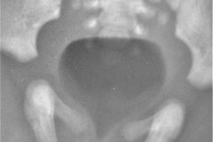fistula-recto-vesical-atresia-anal-aire-en-vejiga-003