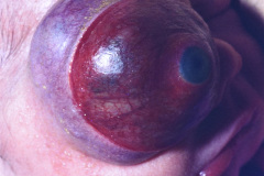fistula-seno-cavernoso-proptosis-000