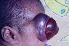 fistula-seno-cavernoso-proptosis-009