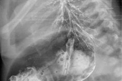 fistula-traqueo-esofagica-focos-aspirativos-broncografia-y-fistulografia-003