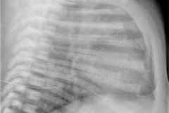 fistula-traqueo-esofagica-focos-aspirativos-broncografia-y-fistulografia-004