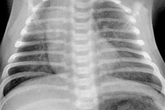 fistula-traqueo-esofagica-focos-aspirativos-broncografia-y-fistulografia-006