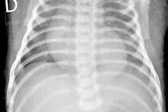 fistula-traqueo-esofagica-focos-aspirativos-broncografia-y-fistulografia-007