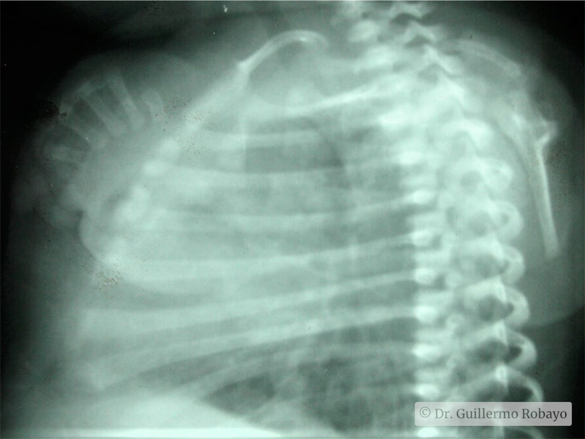 Focomelia Rx Focomelia superior bil – Dr. Guillermo Robayo