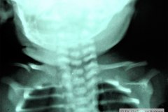 fractura-clavicula-bil-1992-000