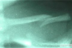 fractura-clavicula-bil-1992-001