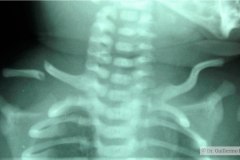 fractura-clavicula-der-1994-000