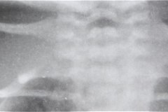 fractura-clavicula-der-1996-000