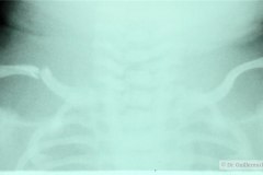 fractura-clavicula-der-2002-000