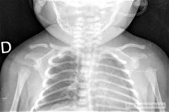 fractura-clavicula-der-2007-000