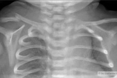 fractura-clavicula-der-2009-000