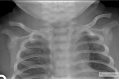 fractura-clavicula-der-2009-001