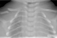 fractura-clavicula-der-2011-11-000