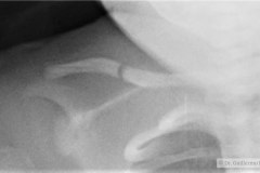 fractura-clavicula-der-2011-000