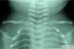 fractura-clavicula-der-epifisis-proximal-1991-000