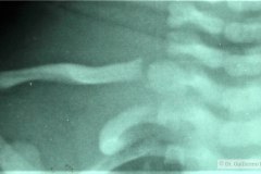 fractura-clavicula-der-epifisis-proximal-1991-001