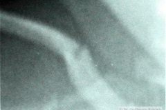 fractura-clavicula-der-incompleta-1992-002