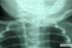 fractura-clavicula-izq-1997-000