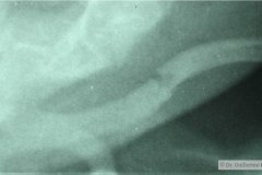 fractura-clavicula-izq-1997-001