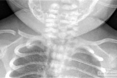 fractura-clavicula-000